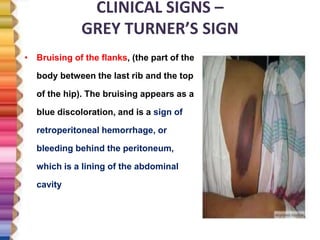 CLINICAL SIGNS –
GREY TURNER’S SIGN
• Bruising of the flanks, (the part of the
body between the last rib and the top
of the hip). The bruising appears as a
blue discoloration, and is a sign of
retroperitoneal hemorrhage, or
bleeding behind the peritoneum,
which is a lining of the abdominal
cavity
 