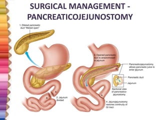 SURGICAL MANAGEMENT -
PANCREATICOJEJUNOSTOMY
 