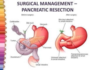 SURGICAL MANAGEMENT –
PANCREATIC RESECTION
 
