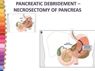 PANCREATIC DEBRIDEMENT –
NECROSECTOMY OF PANCREAS
 