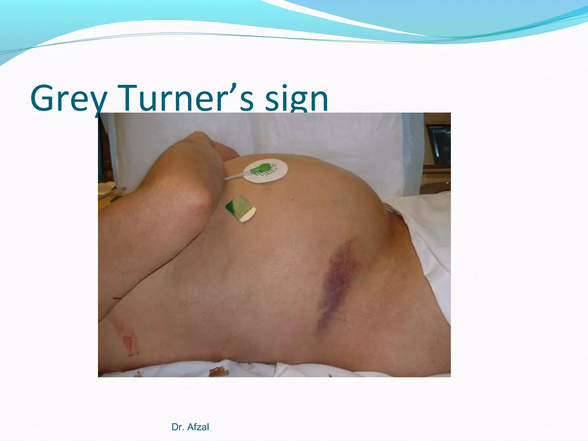 Grey Turner’s sign

Dr. Afzal

 