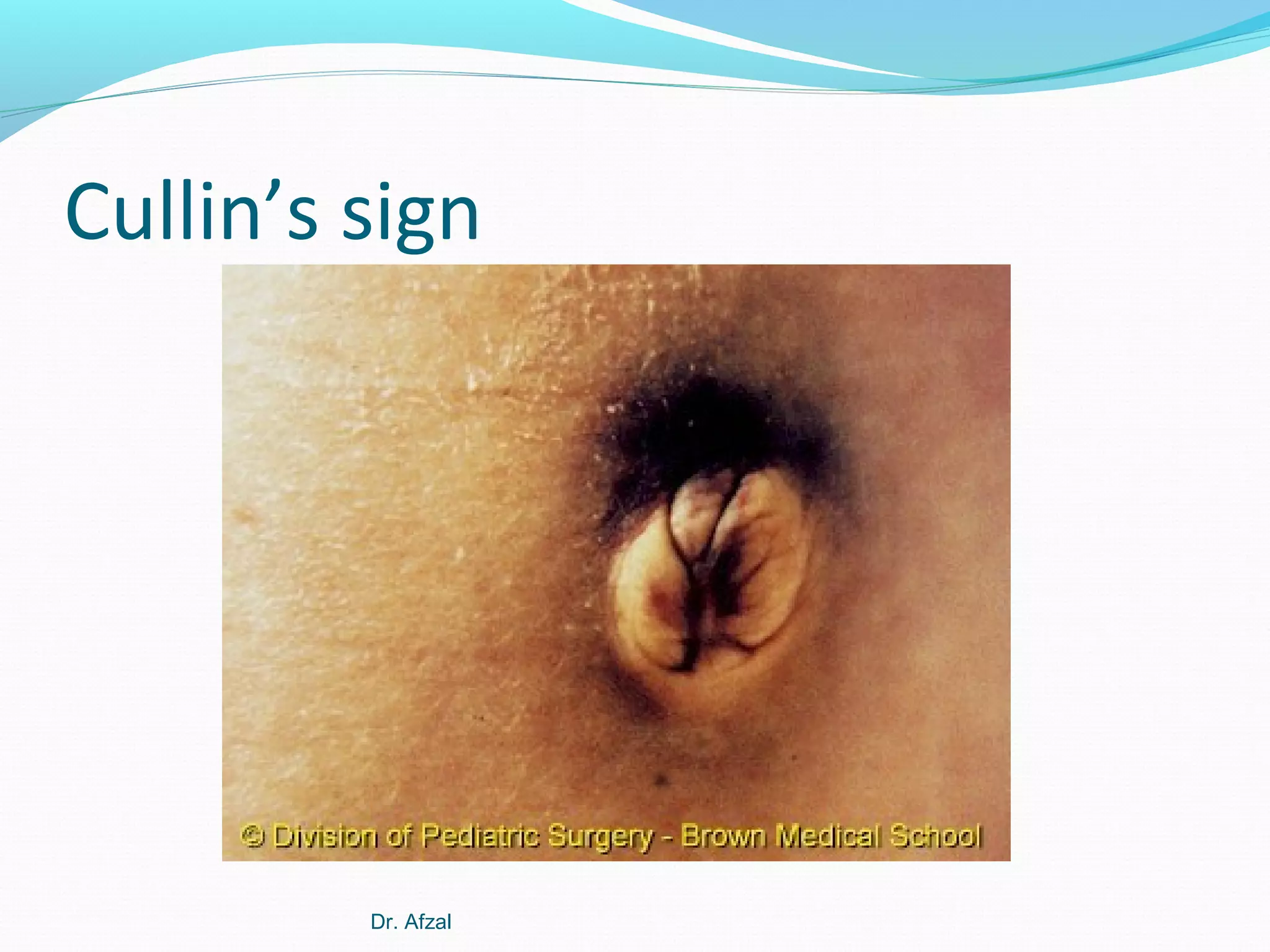 Cullin’s sign

Dr. Afzal

 
