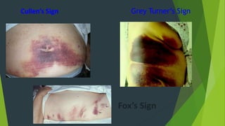 Cullen’s Sign Grey Turner’s Sign
 