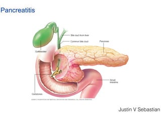 Pancreatitis
Justin V Sebastian
 