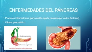 ENFERMEDADES DEL PÁNCREAS
•
•
•
Procesos inﬂamatorios (pancreatitis aguda causada por varios factores)
Cáncer pancreático
 