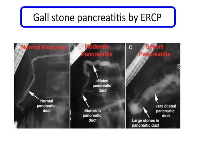 Acute pancreatis , inlamation of the pancrease | PPTX | Blood Disorders ...