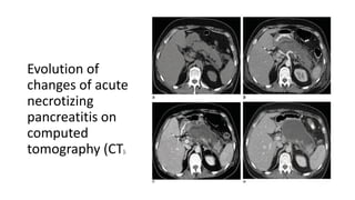 Evolution of
changes of acute
necrotizing
pancreatitis on
computed
tomography (CT).
 