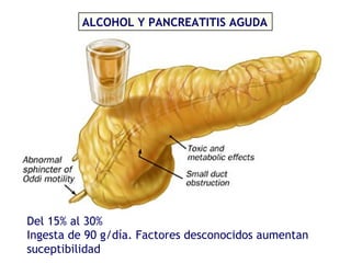 Pancreatitis Aguda Slide 6