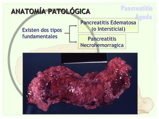 Pancreatitis Aguda Slide 8