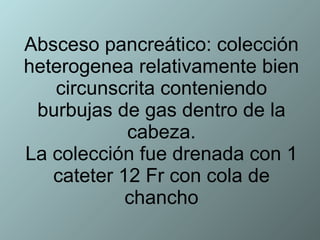 Absceso pancreático: colección heterogenea relativamente bien circunscrita conteniendo burbujas de gas dentro de la cabeza. La colección fue drenada con 1 cateter 12 Fr con cola de chancho 