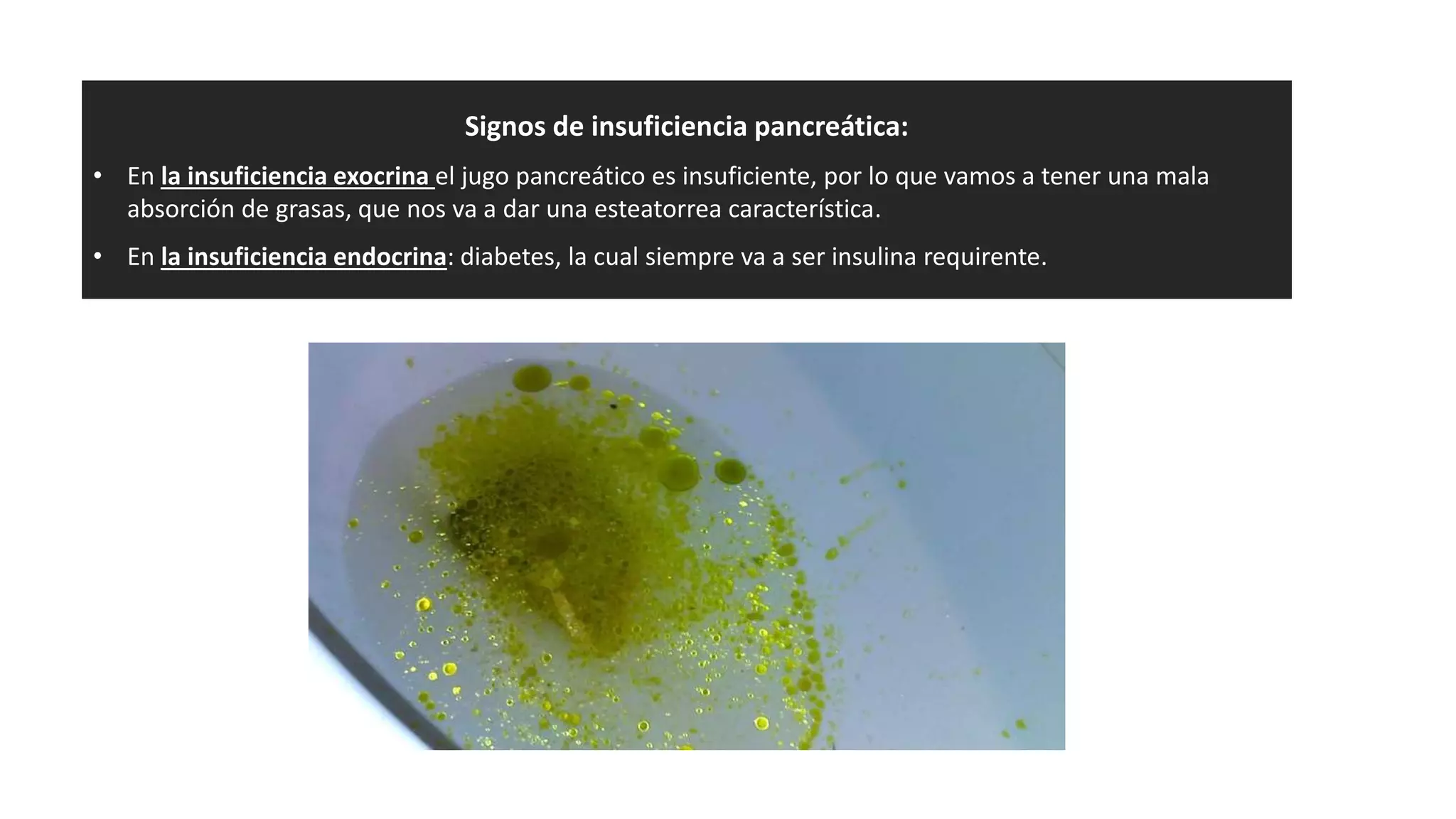 Signos de insuficiencia pancreática:
• En la insuficiencia exocrina el jugo pancreático es insuficiente, por lo que vamos a tener una mala
absorción de grasas, que nos va a dar una esteatorrea característica.
• En la insuficiencia endocrina: diabetes, la cual siempre va a ser insulina requirente.
 