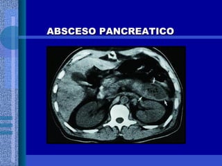 ABSCESO PANCREATICO 