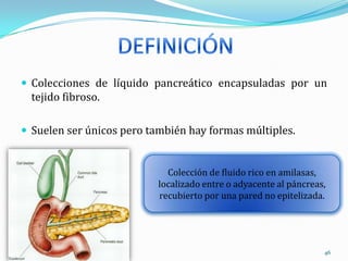 Colecciones de líquido pancreático encapsuladas por un tejido fibroso.Suelen ser únicos pero también hay formas múltiples.DEFINICIÓN Colección de fluido rico en amilasas, localizado entre o adyacente al páncreas, recubierto por una pared no epitelizada. 46