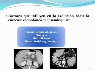 DIAGNÓSTICO DIFERENCIALSe debe hacer con las entidades que cursan con lesiones quísticas en el páncreas 59La principal dificultad diagnóstica es diferenciar por la clínica y los procedimientos de imagen entre un pseudoquiste y otro tipo de lesión quística pancreática.entre las que se encuentran tumores benignos o incluso malignos.