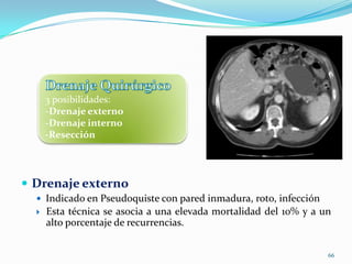 64Drenaje externo percutáneoDrenaje por punción-aspiraciónComplicaciones: infección, oclusión, hemorragia, fístulasMediante esta técnica se pueden drenar los pseudoquistes, tanto infectados como no infectados, en un porcentaje del 67 al 91% de casos