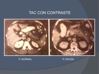 TAC CON CONTRASTE




P. NORMAL          P. AGUDA
 