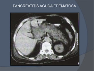 PANCREATITIS AGUDA EDEMATOSA
 