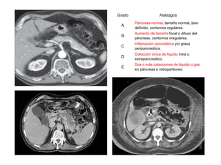 Grado                  Hallazgos
        Páncreas normal, tamaño normal, bien
 A
        definido, contornos regulares.
        Aumento de tamaño focal o difuso del
 B
        páncreas, contornos irregulares.
        Inflamación pancreática y/o grasa
 C
        peripancreática.
        Colección única de líquido intra o
 D
        extrapancreático.
        Dos o más colecciones de líquido o gas
 E
        en páncreas o retroperitoneo.
 