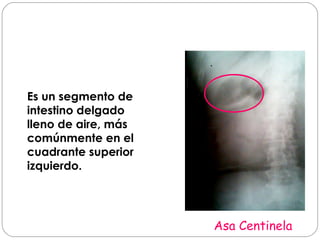 Asa Centinela 
Es un segmento de 
intestino delgado 
lleno de aire, más 
comúnmente en el 
cuadrante superior 
izquierdo. 
 