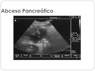 Abceso Pancreático 
 