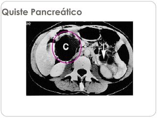 Quiste Pancreático 
 