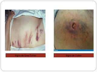 Signo de Grey-Turner Signo de Cullen 
 