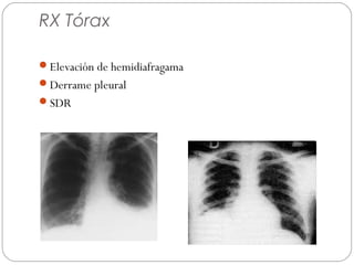 RX Tórax 
Elevación de hemidiafragama 
Derrame pleural 
SDR 
 