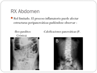 RX Abdomen 
Rol limitado. El proceso inflamatorio puede afectar 
estructuras peripancreáticas pudiéndose observar : 
-Ileo-paralítco -Calcificaciones pancreáticas (P. 
Crónica) 
 