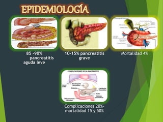 85 -90%
pancreatitis
aguda leve
10-15% pancreatitis
grave
Mortalidad 4%
Complicaciones 20%-
mortalidad 15 y 50%
 