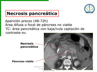 Necrosis pancreática
Aparición precoz (48-72h)
Àrea difusa o focal de páncrees no viable
TC: área pancreática con baja/nula captación de
contraste ev.
Páncreas viable
Necrosis
pancreàtica
Balthazar EJ et al. Imaging and Intervention
in acute pancreatitis. Radiology
1994;193:297-306
 