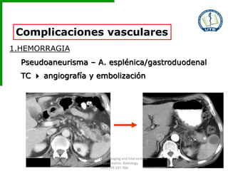 Complicaciones vasculares
1.HEMORRAGIA
Pseudoaneurisma – A. esplénica/gastroduodenal
TC  angiografía y embolización
31-07-04 11-08-04
Balthazar EJ et al. Imaging and Intervention
in acute pancreatitis. Radiology
1994;193:297-306
 