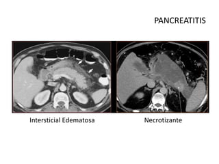 PANCREATITIS
Intersticial Edematosa Necrotizante
 