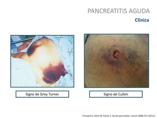 PANCREATITIS AGUDA
.
Clínica
Signo de Grey Turner Signo de Cullen
Frossard JL, Steer M, Pastor C. Acute pancreatitis. Lancet 2008;371:143-52.
 