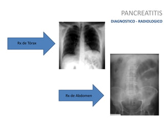 PANCREATITIS
DIAGNOSTICO - RADIOLOGICO
Rx de Tórax
Rx de Abdomen
 