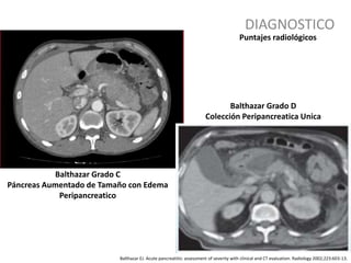DIAGNOSTICO
Balthazar EJ. Acute pancreatitis: assessment of severity with clinical and CT evaluation. Radiology 2002;223:603-13.
Puntajes radiológicos
Balthazar Grado C
Páncreas Aumentado de Tamaño con Edema
Peripancreatico
Balthazar Grado D
Colección Peripancreatica Unica
 