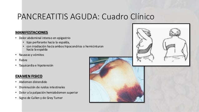 Pancreatitis aguda Pancreatitis aguda