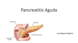 Pancreatitis Aguda
Luis Miguel Angarita
 