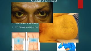 Cuadro Clinico
1. DOLOR (epigastrio e hipocondrio derecho)
 Instauración brusca
 Intenso, en Barra
 Irradia a espalda en un 50%
2. NÁUSEAS Y VÓMITOS
3. En casos severos, Fiebre , taquicardia y Disnea
 