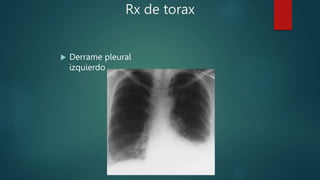 Rx de torax
 Derrame pleural
izquierdo
 