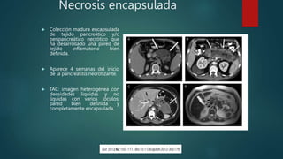 Necrosis encapsulada
 Colección madura encapsulada
de tejido pancreático y/o
peripancreático necrótico que
ha desarrollado una pared de
tejido inflamatorio bien
definida.
 Aparece 4 semanas del inicio
de la pancreatitis necrotizante.
 TAC: imagen heterogénea con
densidades líquidas y no
líquidas con varios lóculos,
pared bien definida y
completamente encapsulada.
 
