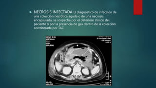  NECROSIS INFECTADA El diagnóstico de infección de
una colección necrótica aguda o de una necrosis
encapsulada, se sospecha por el deterioro clínico del
paciente o por la presencia de gas dentro de la colección
corroborada por TAC
 