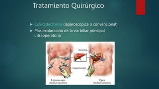 Tratamiento Quirúrgico
 Colecistectomia (laparoscopica o convencional)
 Mas exploración de la via biliar principal
intraoperatoria
 