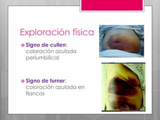 Exploración física
 Signo

de cullen:
coloración azulada
periumbilical

 Signo

de turner:
coloración azulada en
flancos

 