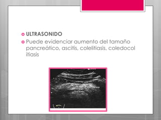  ULTRASONIDO

 Puede

evidenciar aumento del tamaño
pancreático, ascitis, colelitiasis, coledocol
itiasis

 