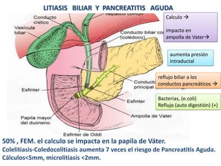 LITIASIS BILIAR Y PANCREATITIS AGUDA
Calculo 
impacto en
ampolla de Vater
aumenta presión
intraductal
reflujo biliar a los
conductos pancreáticos 
Bacterias, (e.coli)
Reflujo (auto digestión) (+)

50% , FEM. el calculo se impacta en la papila de Váter.
Colelitiasis-Coledocolitiasis aumenta 7 veces el riesgo de Pancreatitis Aguda.
Cálculos<5mm, microlitiasis <2mm.

 