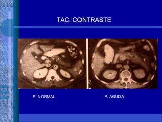 TAC: CONTRASTE
P. NORMAL P. AGUDA
 