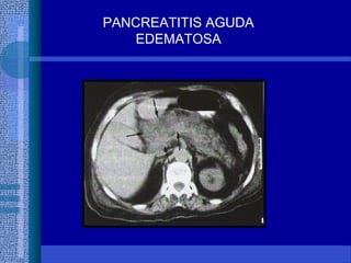 PANCREATITIS AGUDA
EDEMATOSA
 