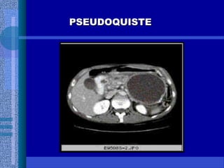 PSEUDOQUISTEPSEUDOQUISTE
 