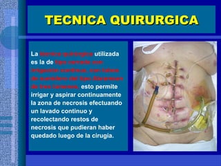 TECNICA QUIRURGICATECNICA QUIRURGICA
La técnica quirúrgica utilizada
es la de tipo cerrada con
irrigación continua, con tubos
de sumidero del tipo Abramson
de tres lúmenes, esto permite
irrigar y aspirar continuamente
la zona de necrosis efectuando
un lavado continuo y
recolectando restos de
necrosis que pudieran haber
quedado luego de la cirugía.
 