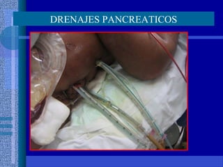 DRENAJES PANCREATICOS
 